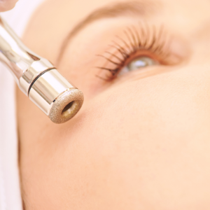 Microdermabrasie