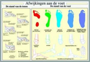 Poster afwijkingen van de voet 40 x 60, geplastificeerd